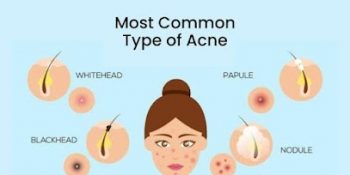 Know more about types of acne.