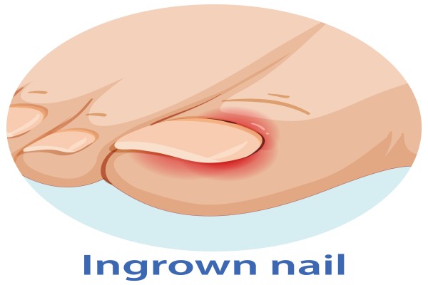 Ingrown Nail