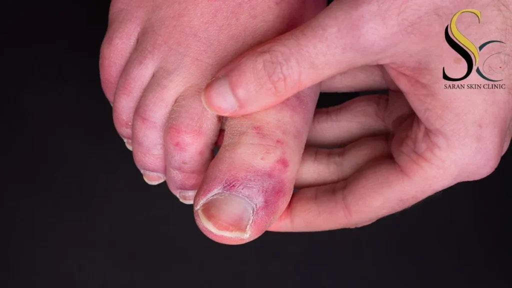 Chilblains - Dr. Jitendra Saran