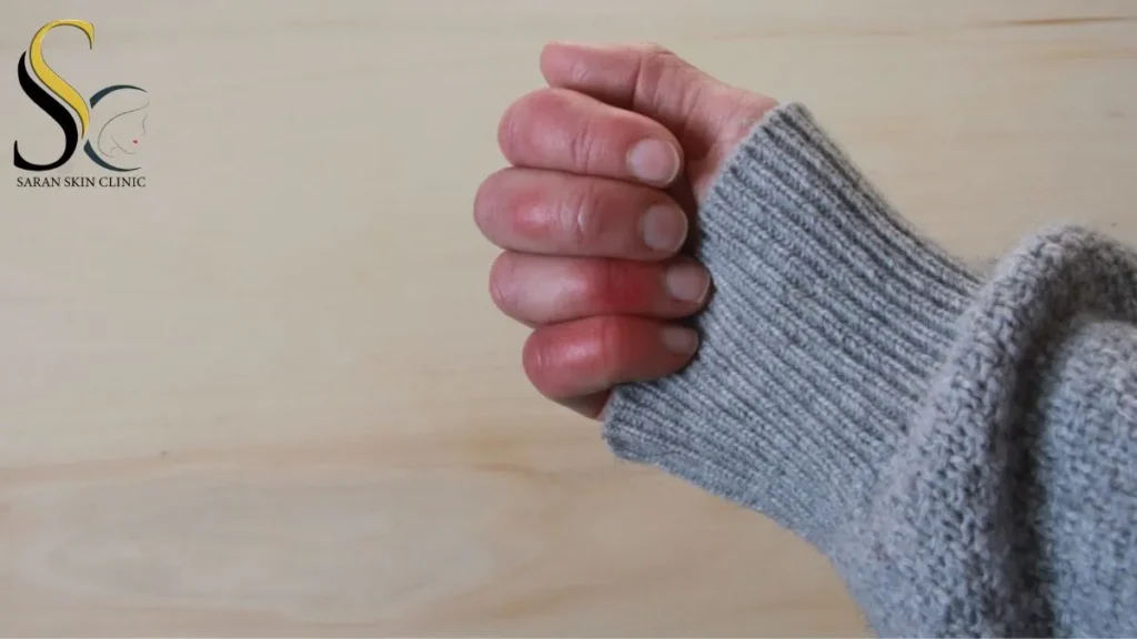 Chilblains - Saran Skin Clinic