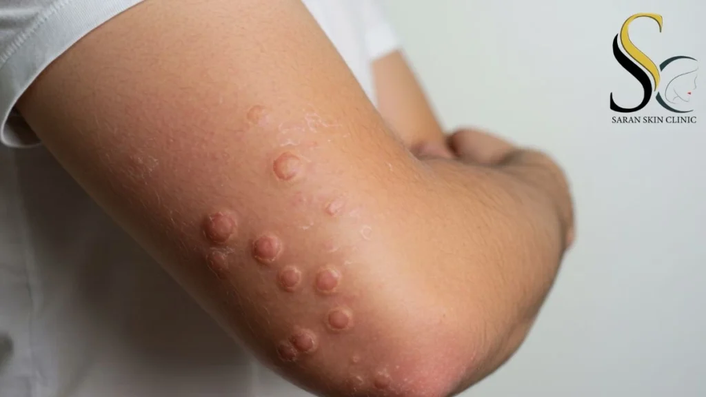 Molluscum Contagiosum - Dr. Jitendra Saran