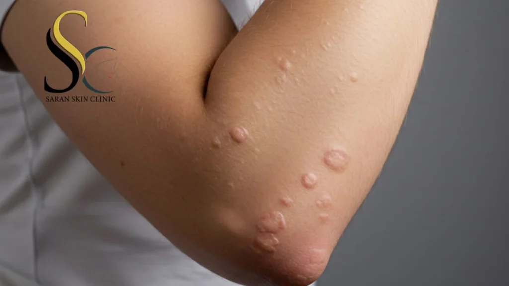 Molluscum Contagiosum in Children - Saran Skin Clinic