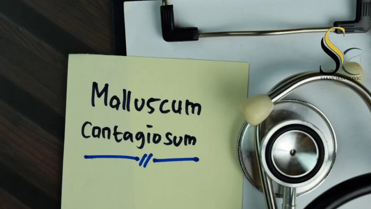 Molluscum Contagiosum in Children and Adults