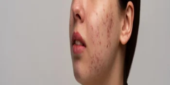 Is Subcision Good for Acne Scars? Complete Treatment Guide